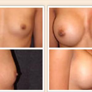 Boob Job Price - Healthy Breast Tips - Make Your Small Breasts Seem Bigger And Fuller Without The Risks